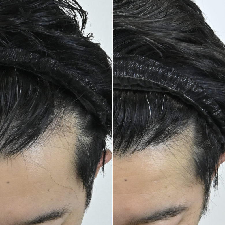 薄毛治療