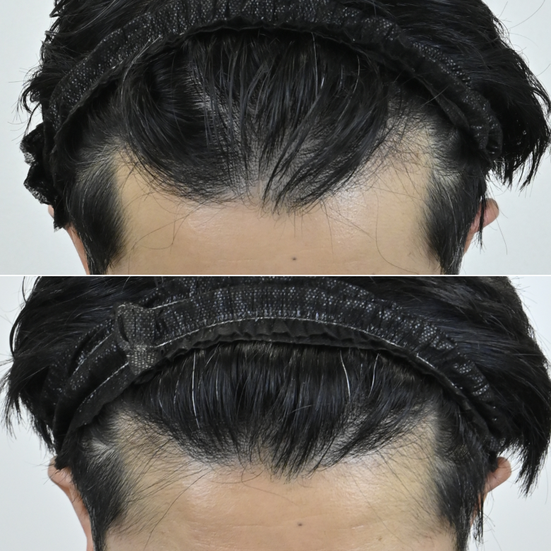 薄毛治療