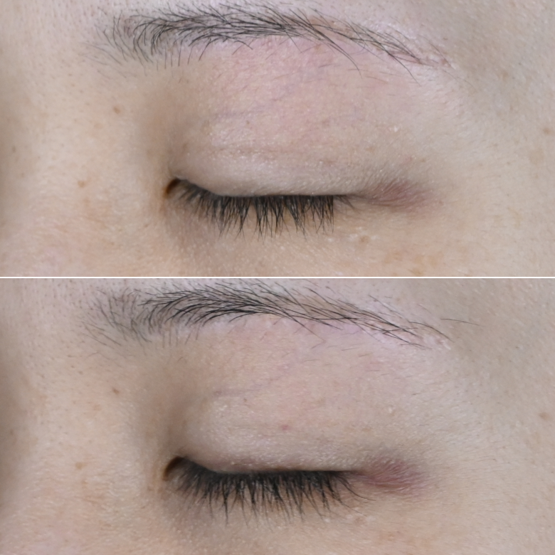 まつ毛治療