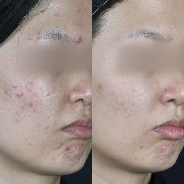 四合剤3か月後の症例